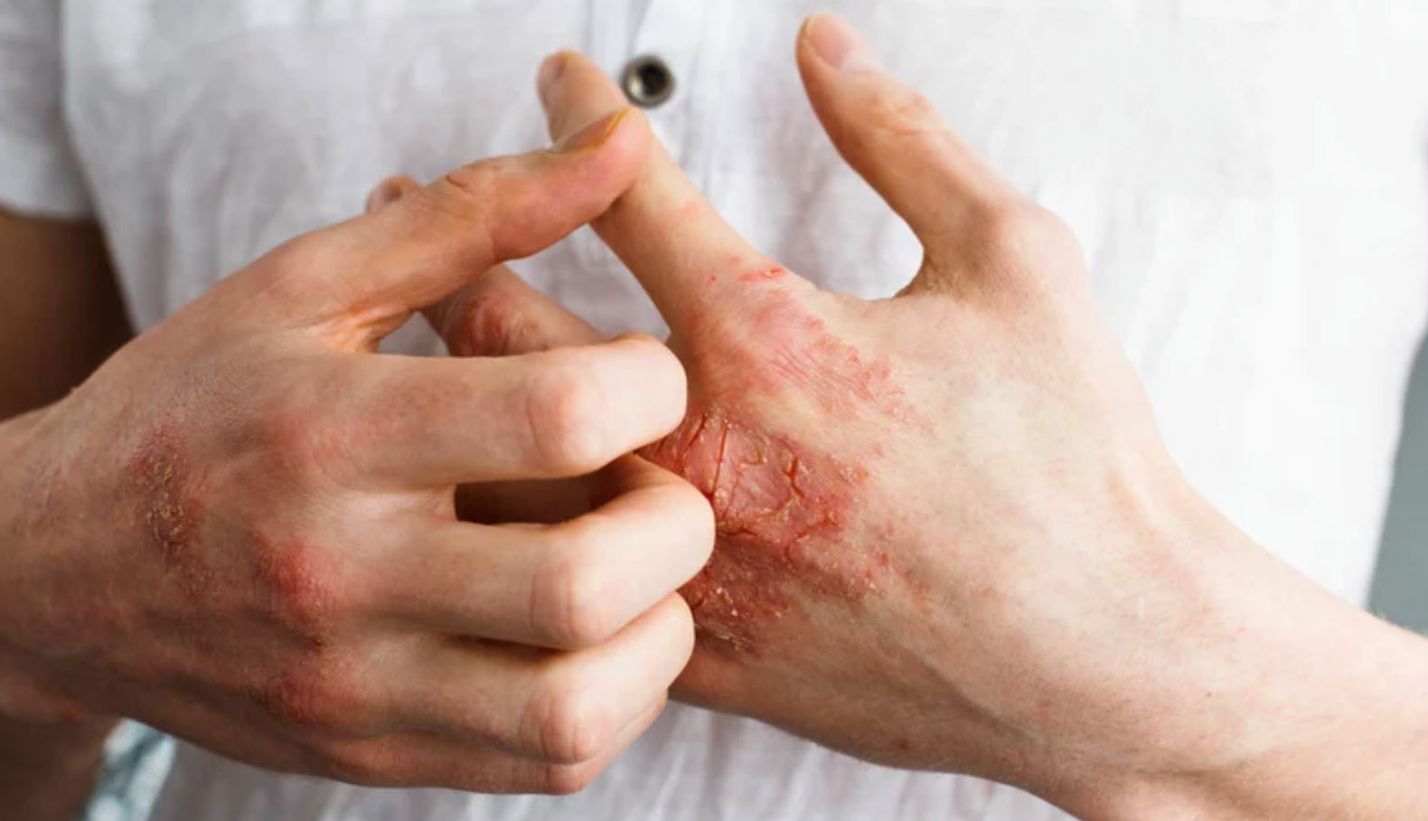 Dermatite Atópica: Causas e Tratamento, saiba como lidar